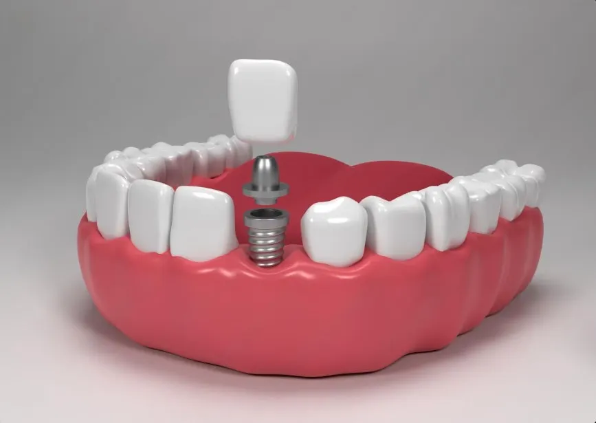 how long do dental implants last