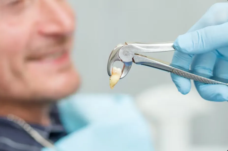 broken infected tooth extraction guide